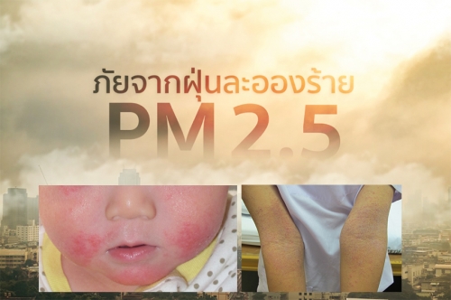 แพทย์เตือน วิกฤติฝุ่น PM 2.5 ตัวการทำ ‘ผื่นภูมิแพ้ผิวหนัง’ กำเริบ